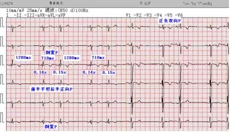 另类心电图讲义-8---心脏传导阻滞-房室传导阻