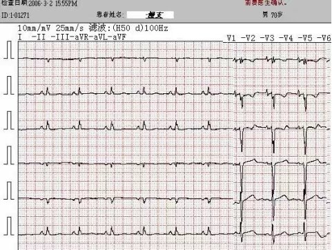另类心电图讲义-10--心脏肥大(2)